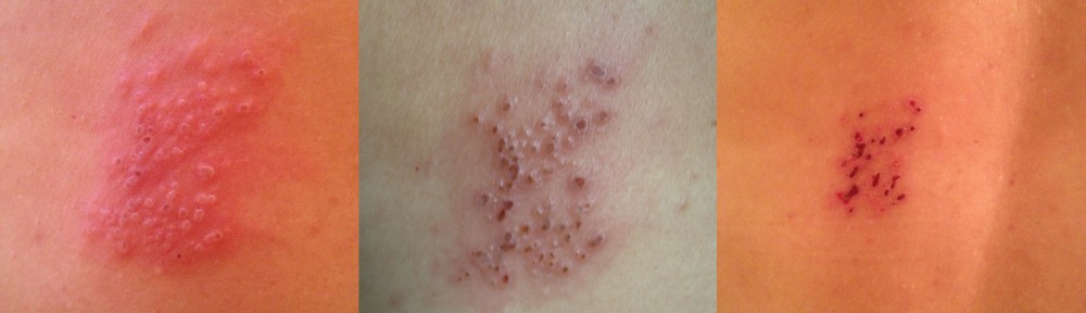 Varicella-Zoster Strikes Again