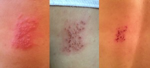 Shingles on day 3, 6, and 11
