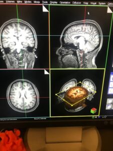 A picture of my MRI scan from the coronal, sagittal, and horizontal views.