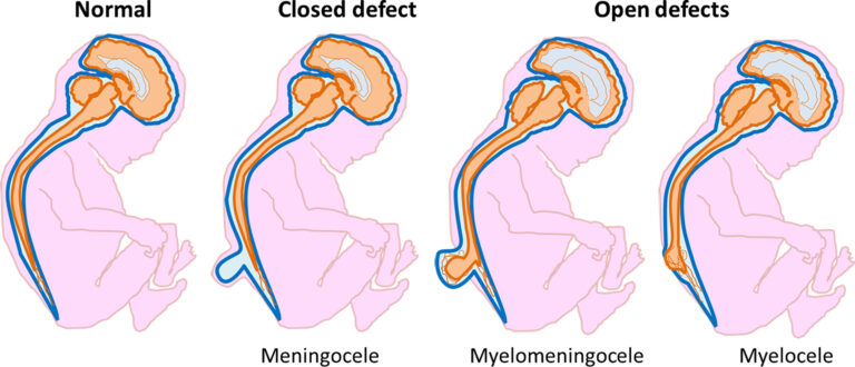 Possible New Therapies for Deadly Neural Tube Defects!