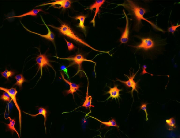Treating U87 EGFP Glibolastoma Cells with Nickel Sulfate!