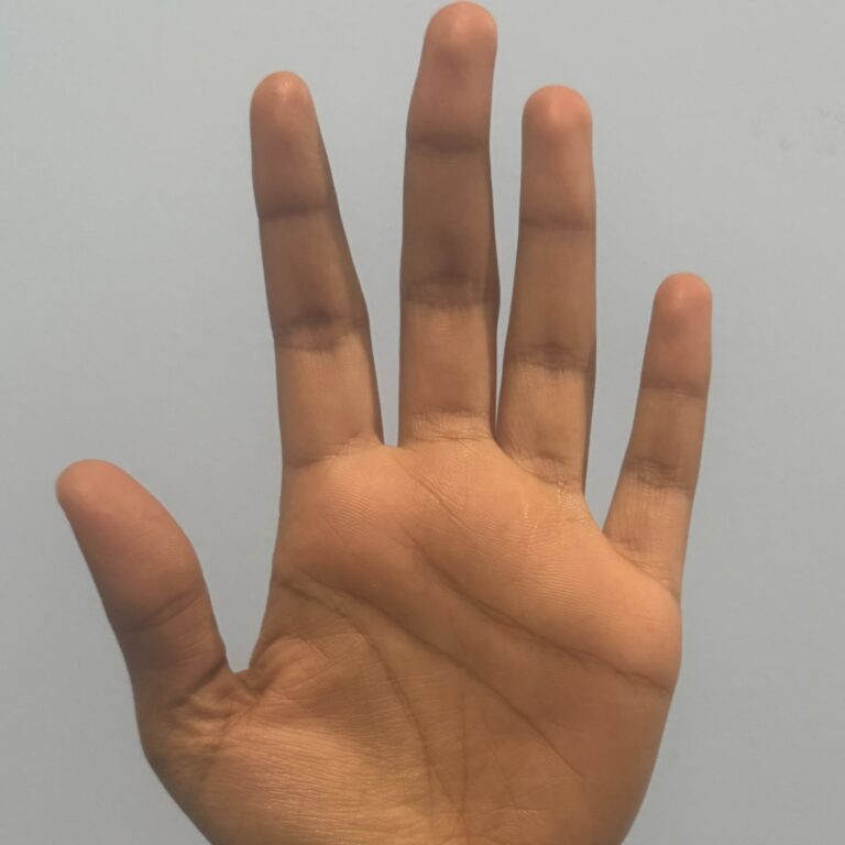 The Future of Touch: How Neural Networks are Revolutionizing Prosthetics